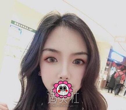 王琪影,双眼皮
