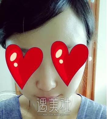 贵阳注射隆鼻果如何?相关案例一览~