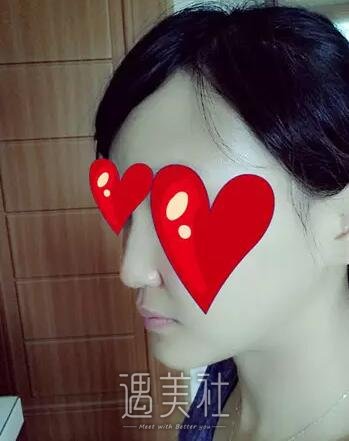 贵阳注射隆鼻果如何?相关案例一览~