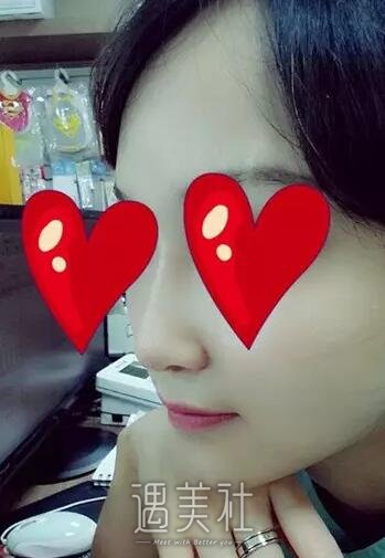 贵阳注射隆鼻果如何?相关案例一览~