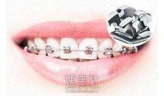 厦门牙齿矫正价格是多少?影响因素都有哪些? width=
