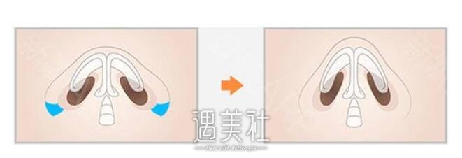 鼻翼缩小都有哪些后遗症?我们该如何避免?