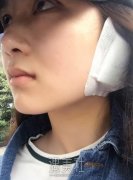 大连瑞丽整形医院价目表|耳软骨隆鼻真实案例分享~ width=