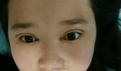 保定蓝山整形医院价目表|153天全切双眼皮+提肌真实案例~ width=