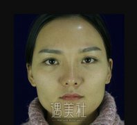 黄大勇下颌角手术价格大约多少?听说有点贵! width=