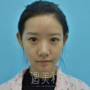 杭州维多利亚许凤芝案例：许医生的技术真的不错~ width=
