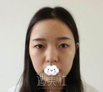 南京中大王磊做双眼皮案例：做了双眼皮都可以当模特了！ width=