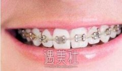 北京大学深圳医院牙齿矫正价格多少钱？贵不贵？ width=