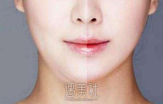 面部吸脂
