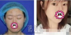 吴坤南双眼皮修复案例：一个月果恢复展示 width=