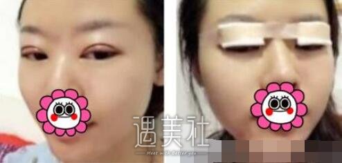 吴坤南,双眼皮修复
