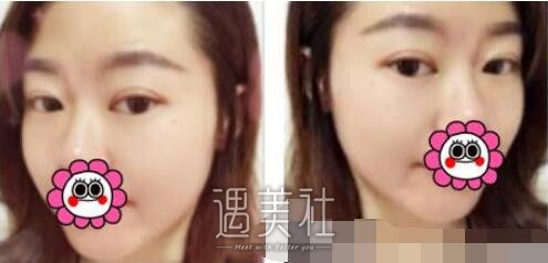 吴坤南,双眼皮修复