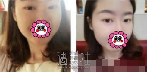 吴坤南,双眼皮修复
