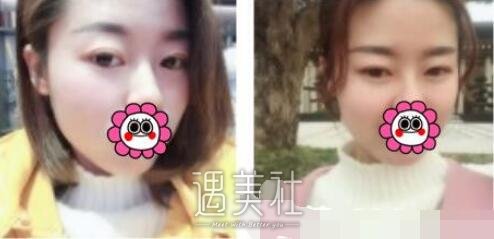 吴坤南,双眼皮修复