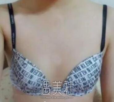 李罡,隆胸