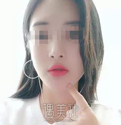 南京鼓楼医院整形科怎么样?有颧骨内推相关案例吗?