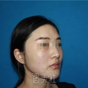 南京鼓楼医院整形科怎么样?有颧骨内推相关案例吗? width=