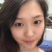 成都西蝉美容医院双眼皮怎么样?我也想逆天改命! width=