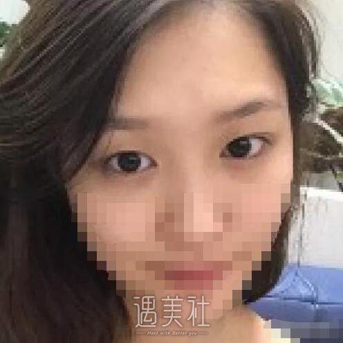 成都西蝉美容医院双眼皮怎么样?我也想逆天改命!