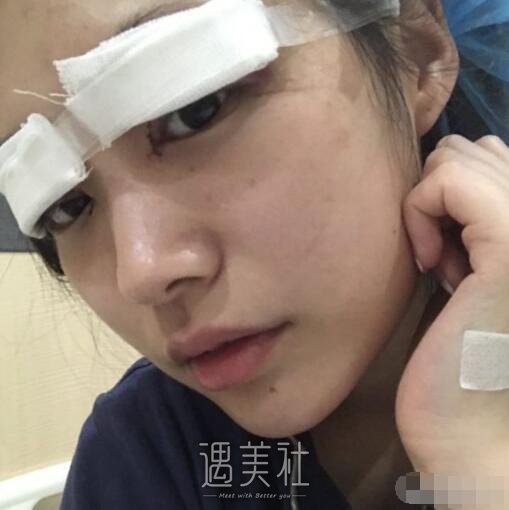 成都西蝉美容医院双眼皮怎么样?我也想逆天改命!