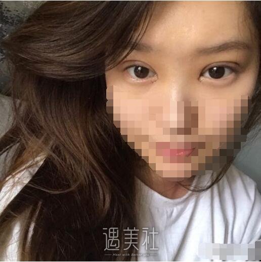 成都西蝉美容医院双眼皮怎么样?我也想逆天改命!