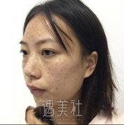 彩光祛斑恢复过程图片分享|彩光祛斑真实记录~ width=