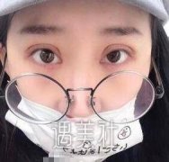 西京张辉双眼皮案例图：这双眼皮宛如天生呐~ width=