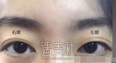 钱文江,全切双眼皮