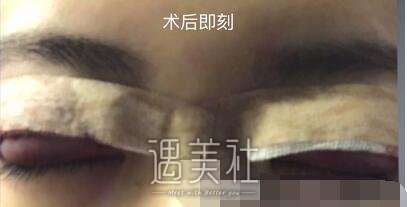 钱文江,全切双眼皮
