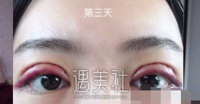 钱文江,全切双眼皮