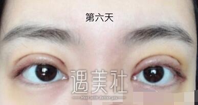 钱文江,全切双眼皮