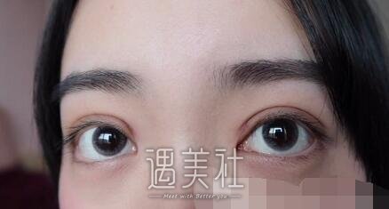 钱文江,全切双眼皮