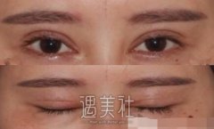 杨明峰双眼皮修复案例：现在就很自然了~ width=