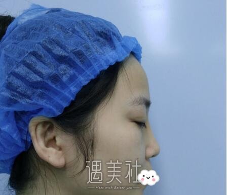 上海,邱文苑,隆鼻