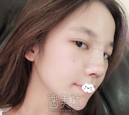 上海,邱文苑,隆鼻