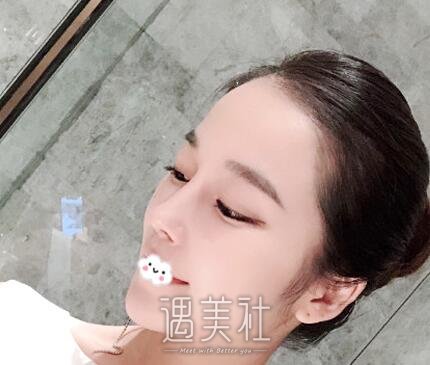 上海,邱文苑,隆鼻
