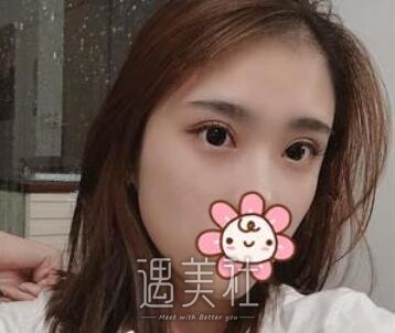 薛旦,割双眼皮