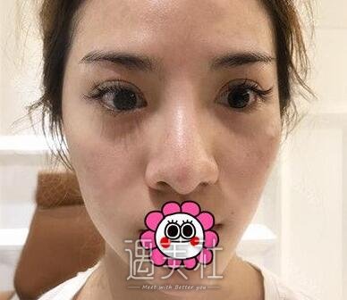 靳小雷,隆鼻