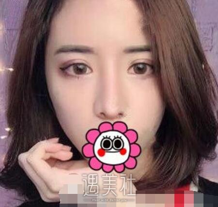 靳小雷,隆鼻