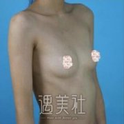 广州军美王世虎隆胸案例：在性感面前可爱不值一提 width=