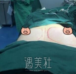 广州军美,王世虎,隆胸