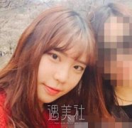 上海九院陈辉隆鼻案例：一个月恢复过程图+心得分享 width=