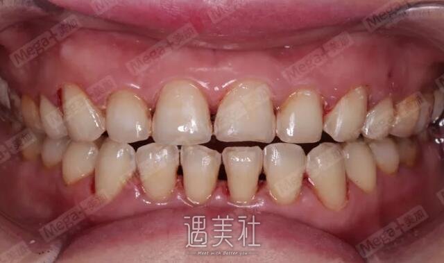 烤瓷牙修复前后图片|烤瓷牙修复案例分享~