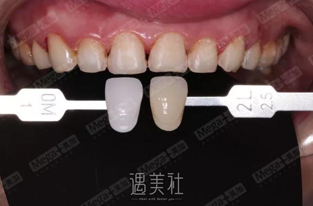 烤瓷牙修复前后图片|烤瓷牙修复案例分享~