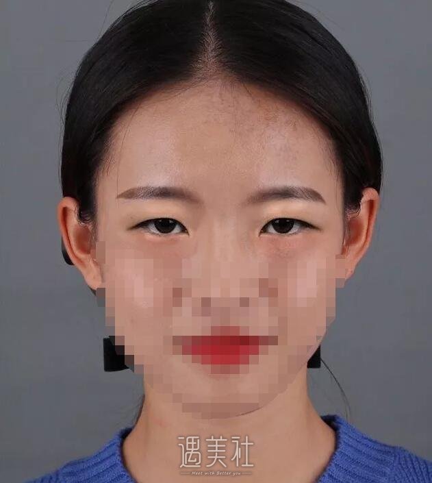 济南薛峰双眼皮案例：宽度刚刚好是我想要的!
