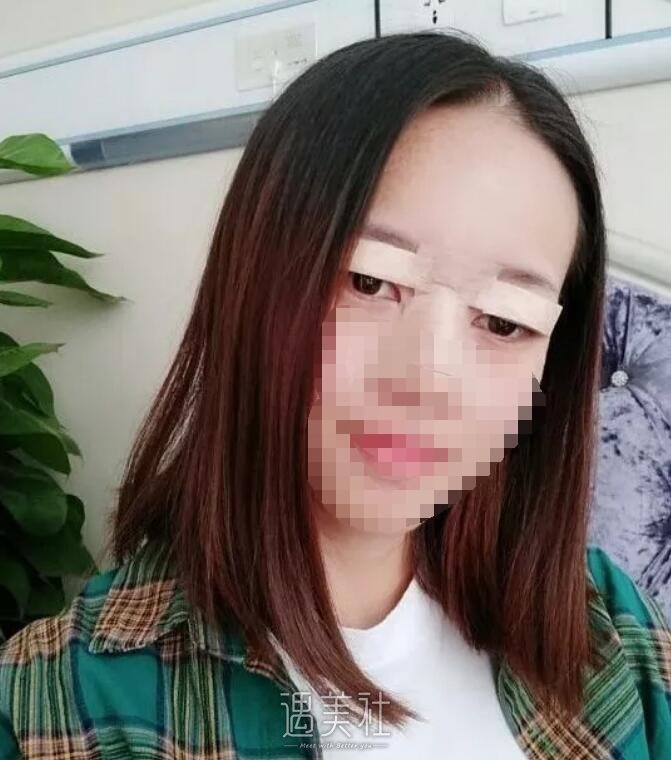 济南薛峰双眼皮案例：宽度刚刚好是我想要的!
