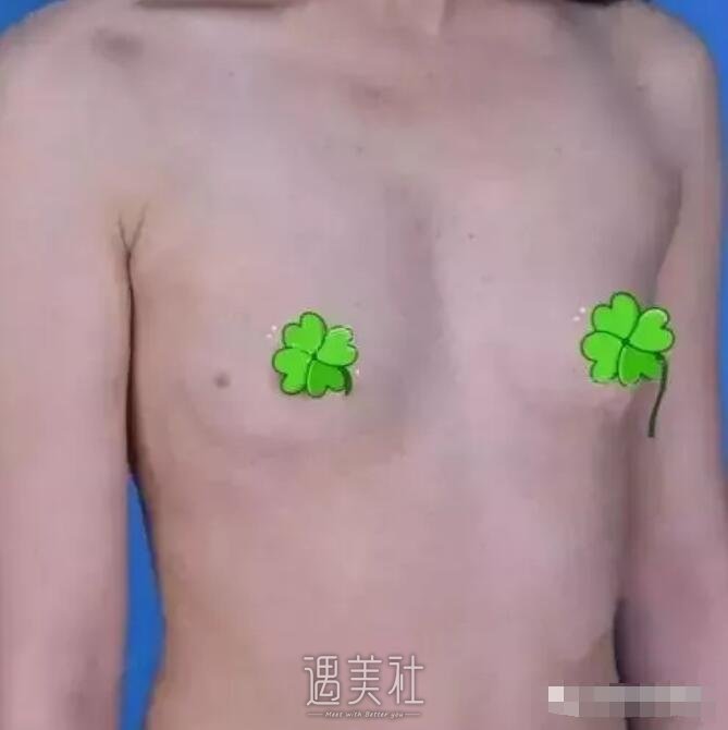 嘉兴禾美医院正规吗?2019隆胸案例分享~