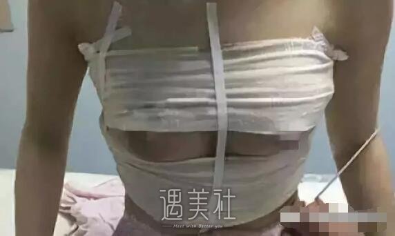 嘉兴禾美医院正规吗?2019隆胸案例分享~