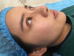 南京施尔美整形价目表|孙欣双眼皮真实案例对比手札~ width=