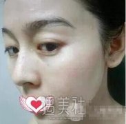 成都华西医院去红血丝好不?有近期案例吗? width=